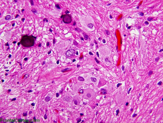 Subependymal giant cell astrocytoma x400